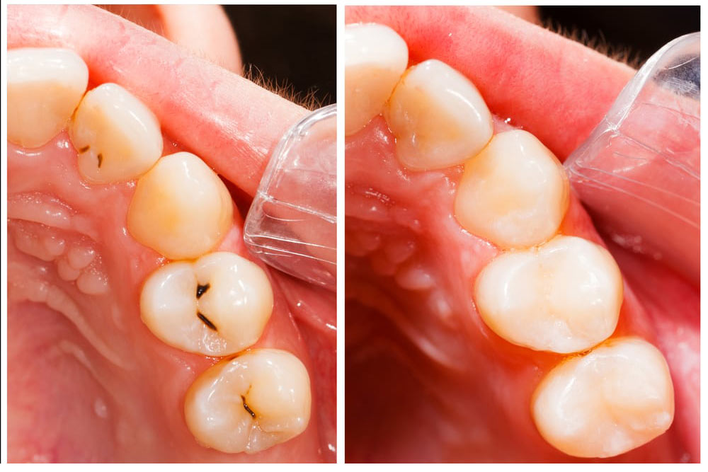 composite dental filling procedure