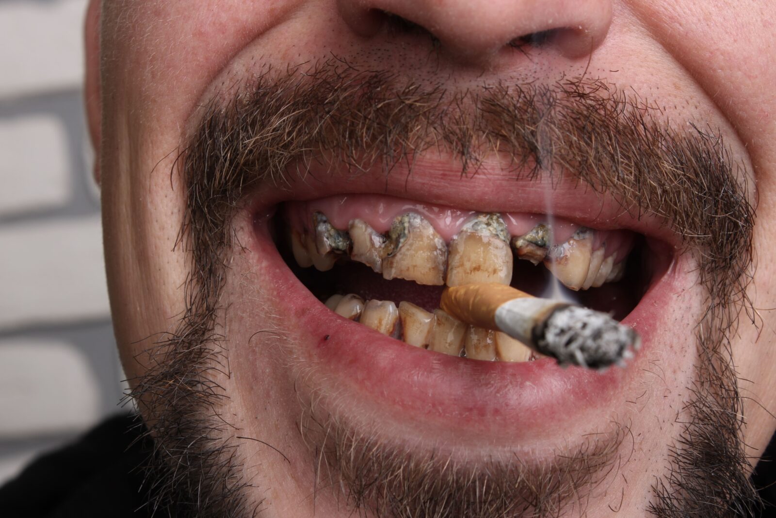 What Tobacco Does To Your Oral Health Birch Point Dental Clinic Thunder Bay On